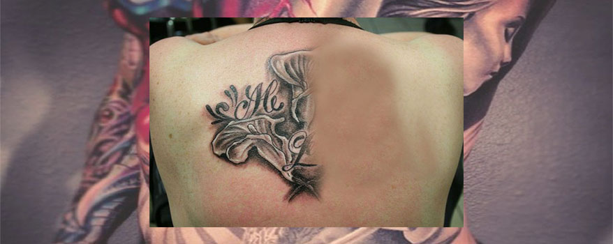 Tattoo Removal, tattoo removal, laser tattoo removal, tattoo removal surgery, tattoo removal by surgery, tattoo removal by laser,
