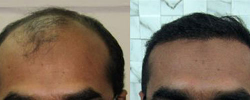 Hair transplant bnefits at care Well