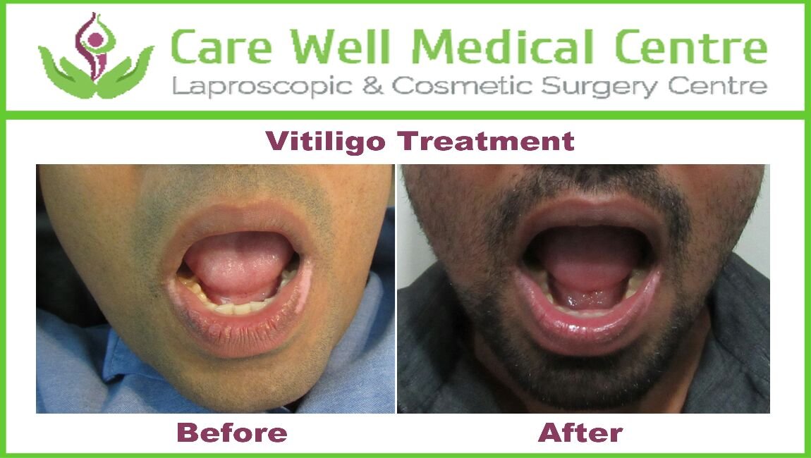 Melanocyte Transplant Treatment for Vitiligo