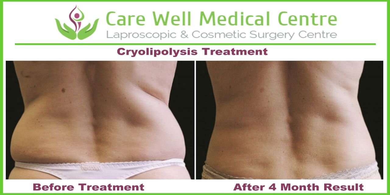 Melanocyte Transplant Treatment for Vitiligo