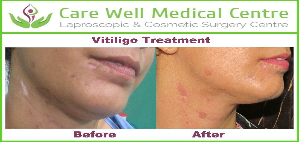 Melanocyte Transplant Treatment for Vitiligo