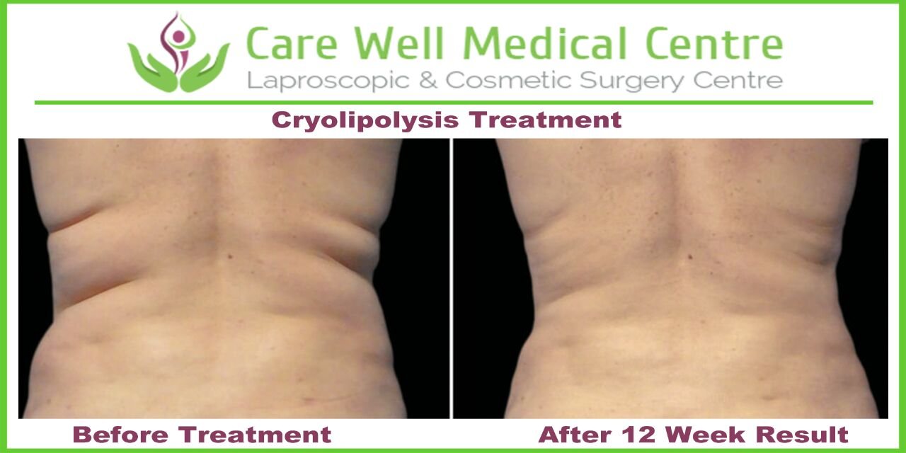 Melanocyte Transplant Treatment for Vitiligo