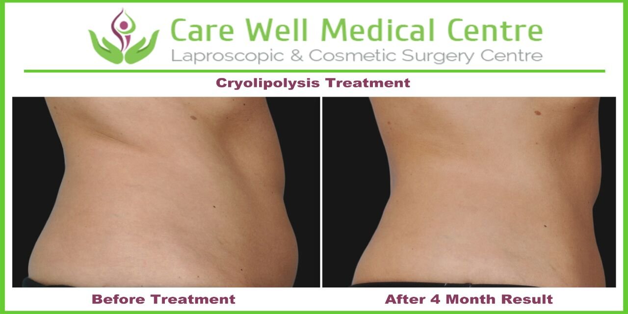 Melanocyte Transplant Treatment for Vitiligo