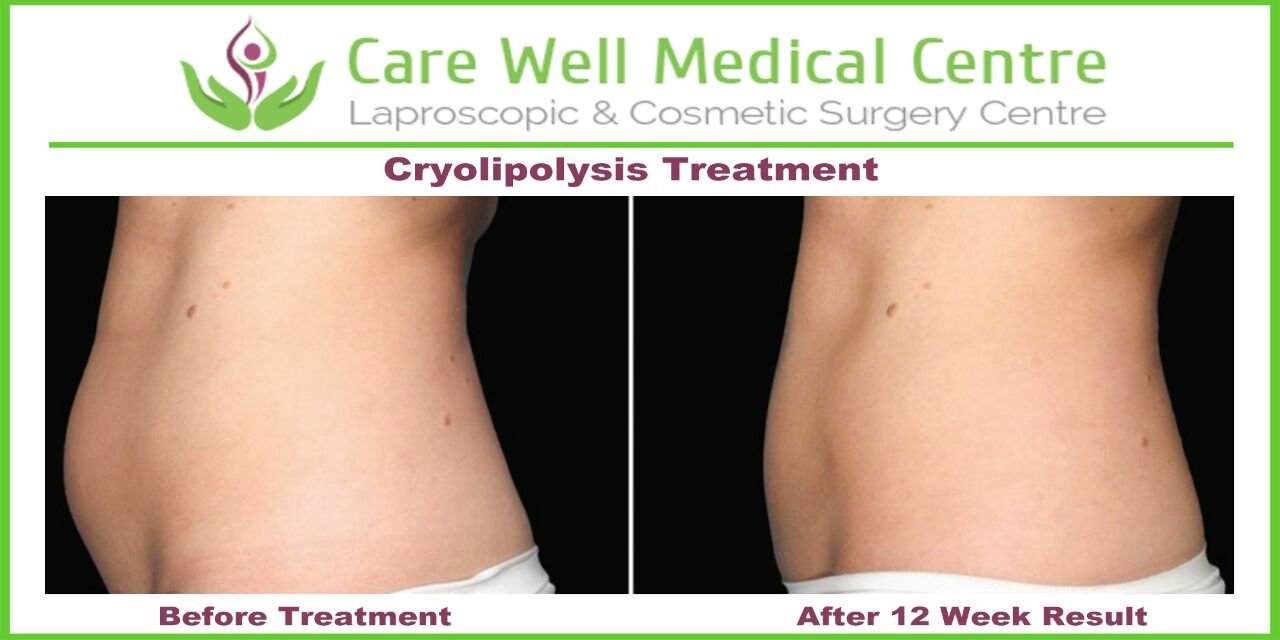 Melanocyte Transplant Treatment for Vitiligo
