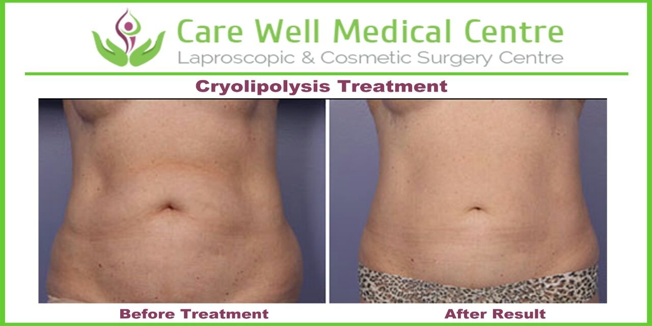 Melanocyte Transplant Treatment for Vitiligo