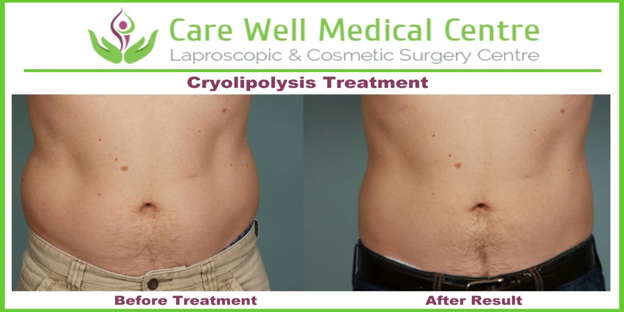 Melanocyte Transplant Treatment for Vitiligo