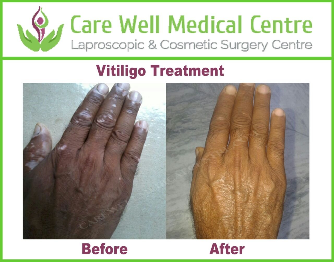 Melanocyte Transplant Treatment for Vitiligo
