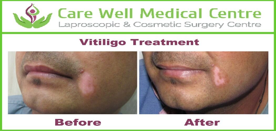 Melanocyte Transplant Treatment for Vitiligo