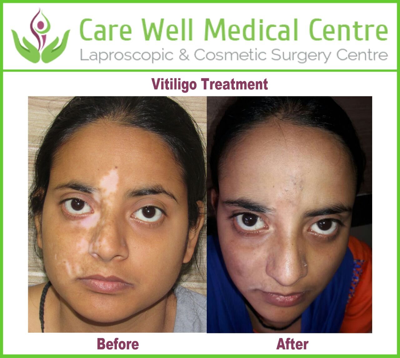 Melanocyte Transplant Treatment for Vitiligo