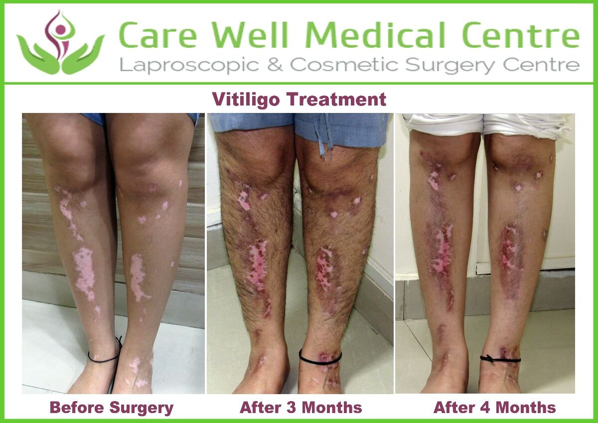 Melanocyte Transplant Treatment for Vitiligo