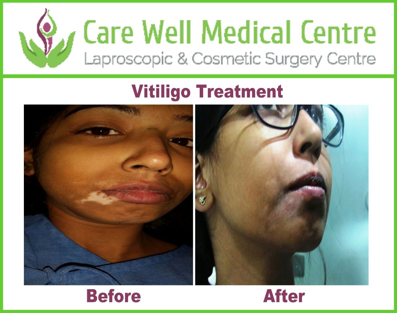 Melanocyte Transplant Treatment for Vitiligo