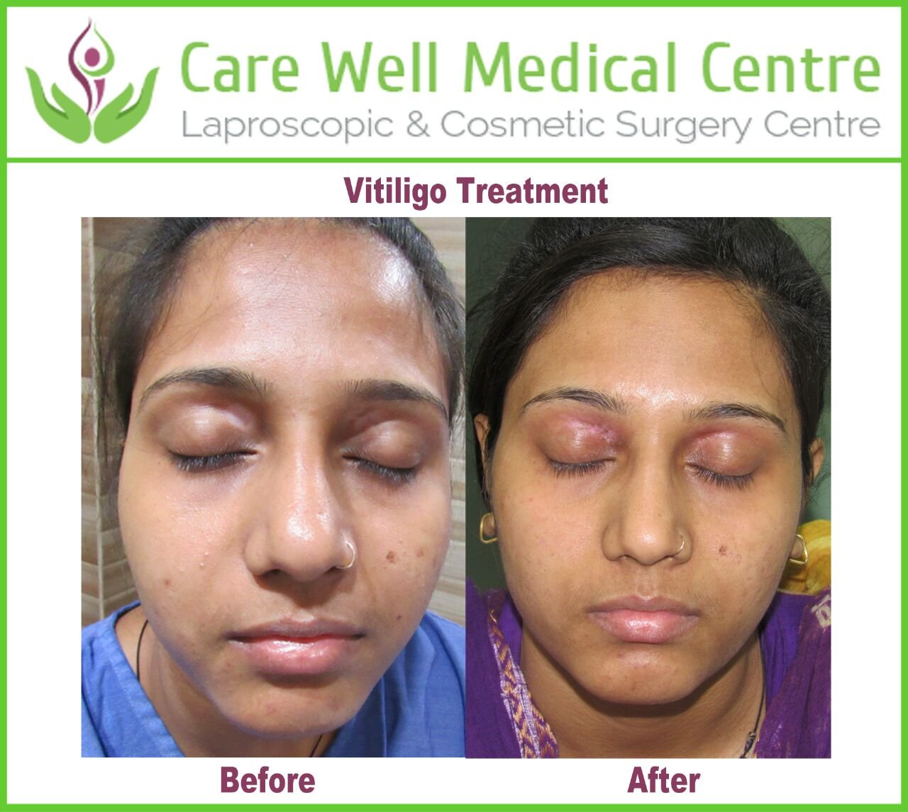 Melanocyte Transplant Treatment for Vitiligo