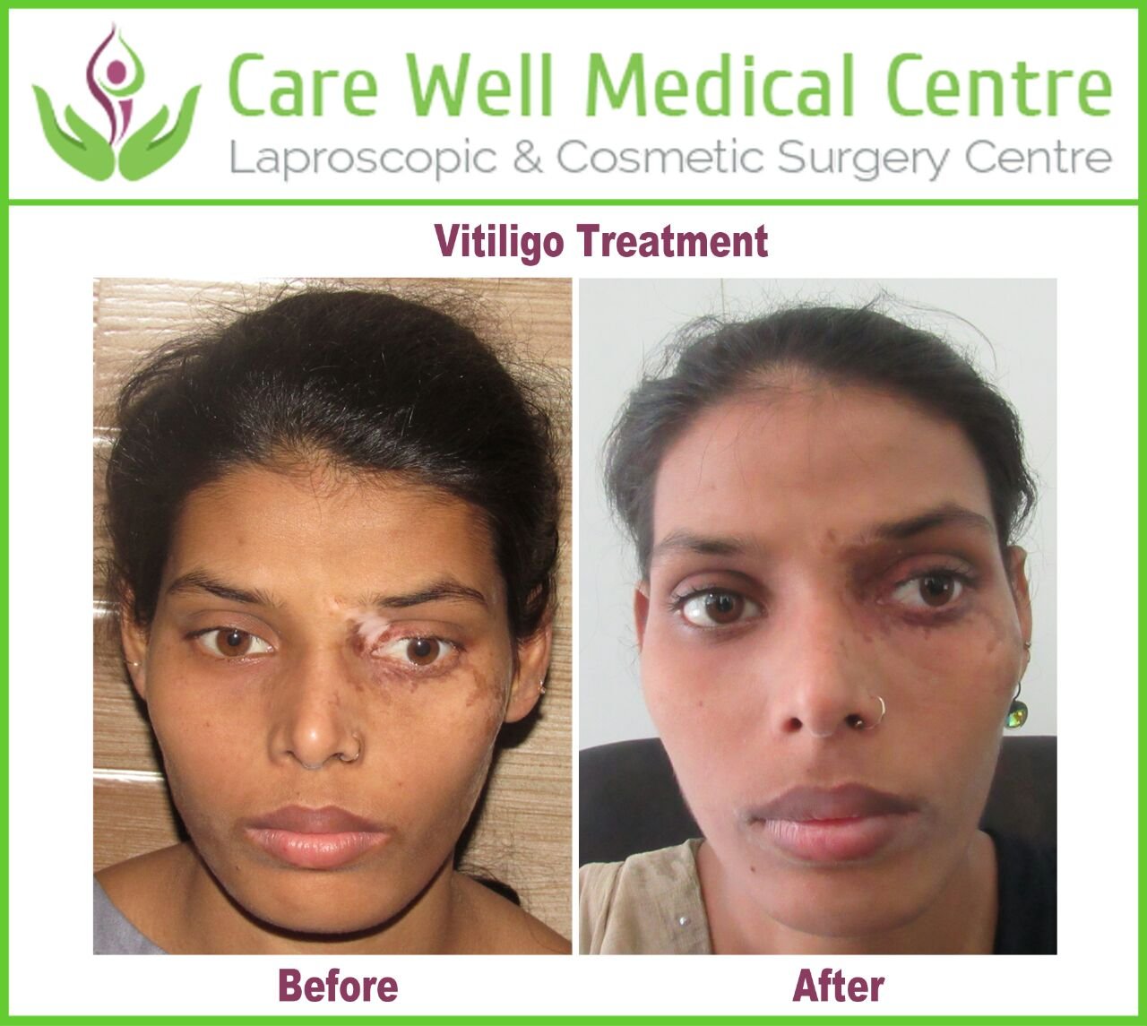 Melanocyte Transplant Treatment for Vitiligo